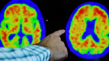 Descoberta primeira transmissão acidental da doença de Alzheimer