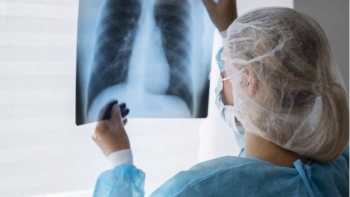Portugal está no nível zero na luta contra o cancro do pulmão