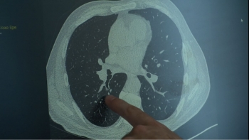 Programa nacional de rastreio para o cancro do pulmão (vídeo)