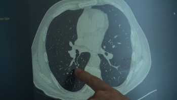 Região deverá avançar com o rastreio ao cancro do pulmão em março (áudio)