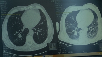 Madeira regista 120 novos casos de cancro do pulmão (vídeo)