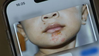 Madeira enfrenta um surto de impetigo (vídeo)