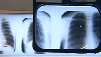 Imagem de Cancro do pulmão está a aumentar na Madeira (vídeo)