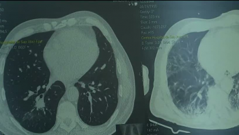 Imagem de Casos de cancro no pulmão têm aumentado (áudio)