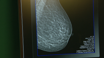 Imagem de 220 casos de cancro da mama por ano (vídeo)