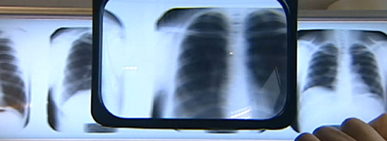 Imagem de Pneumonia é a principal causa de mortalidade respiratória na Madeira (vídeo)