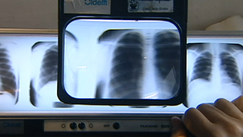 Imagem de Pneumonia é a principal causa de mortalidade respiratória na Madeira (vídeo)