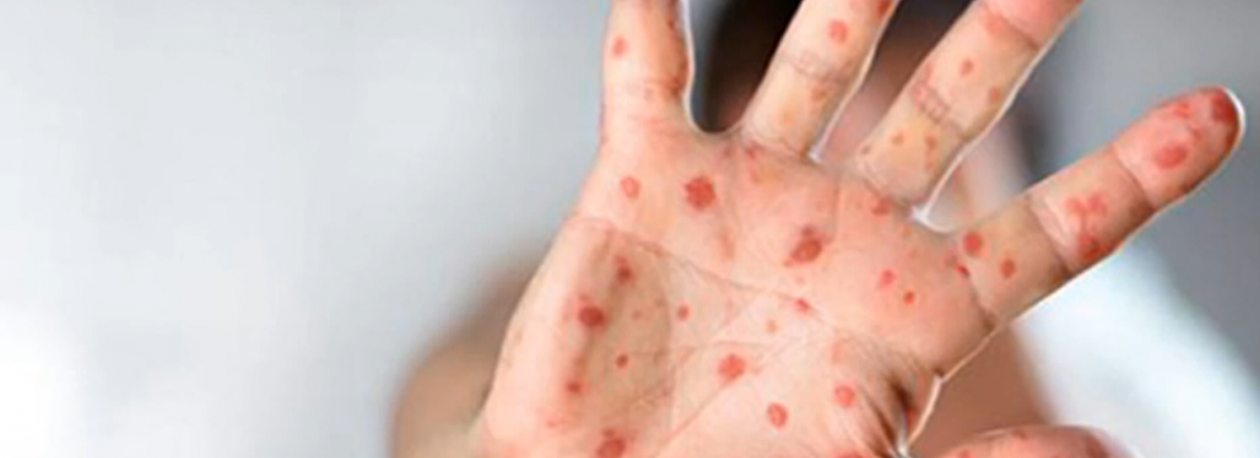 Imagem de Caso de sarampo detetado na Madeira (vídeo)