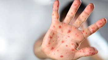 Imagem de Caso de sarampo detetado na Madeira (vídeo)