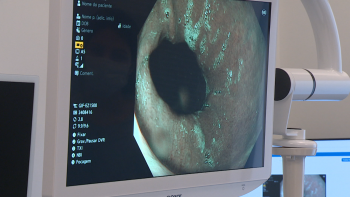 Imagem de Projeto Europeu ao Cancro do Estômago detetou lesões importantes (vídeo)