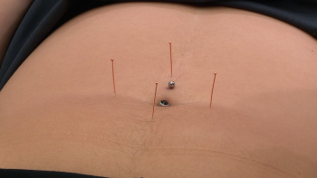 Imagem de Acupuntura é dos tratamentos mais procurados (vídeo)