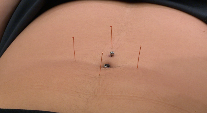 Imagem de Acupuntura é dos tratamentos mais procurados (vídeo)
