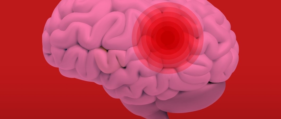 Imagem de Madeira regista cerca de 600 a 700 casos de AVC por ano (áudio)