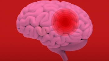 Imagem de Madeira regista cerca de 600 a 700 casos de AVC por ano (áudio)