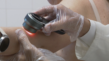 40 casos de melanoma por ano (vídeo)