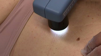 Farmacêuticas anunciam resultados positivos para vacina experimental contra melanoma