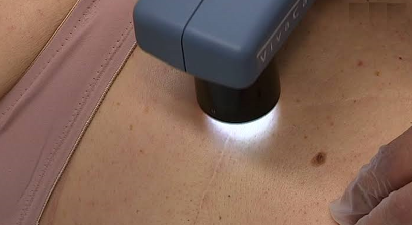 Farmacêuticas anunciam resultados positivos para vacina experimental contra melanoma